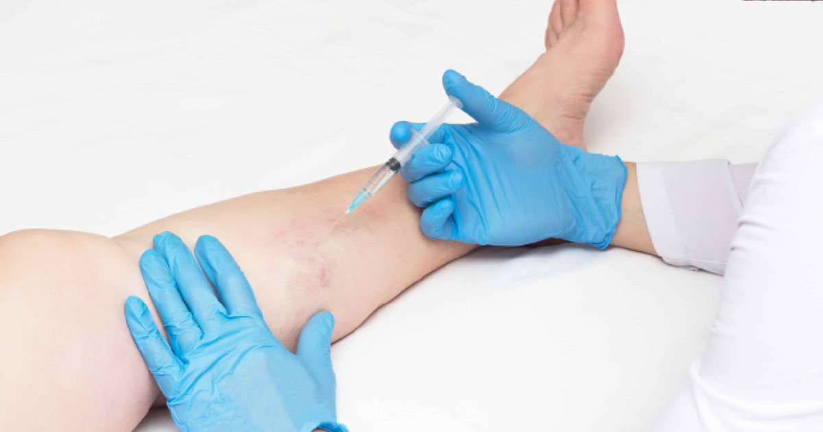 Medical professional injecting a patient’s leg with sclerotherapy to treat spider or varicose veins, wearing blue gloves in a clinical setting in Tucson, AZ