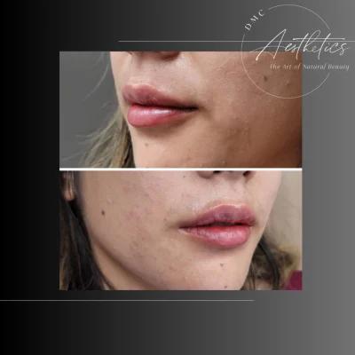 Case 2501 View Angle Lateral